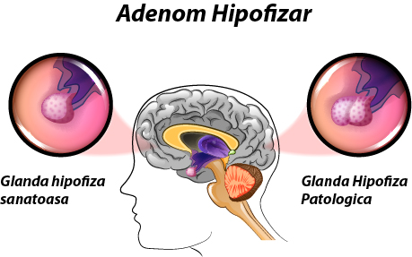 Adenom Hipofizar ilustratie normal vs patologic